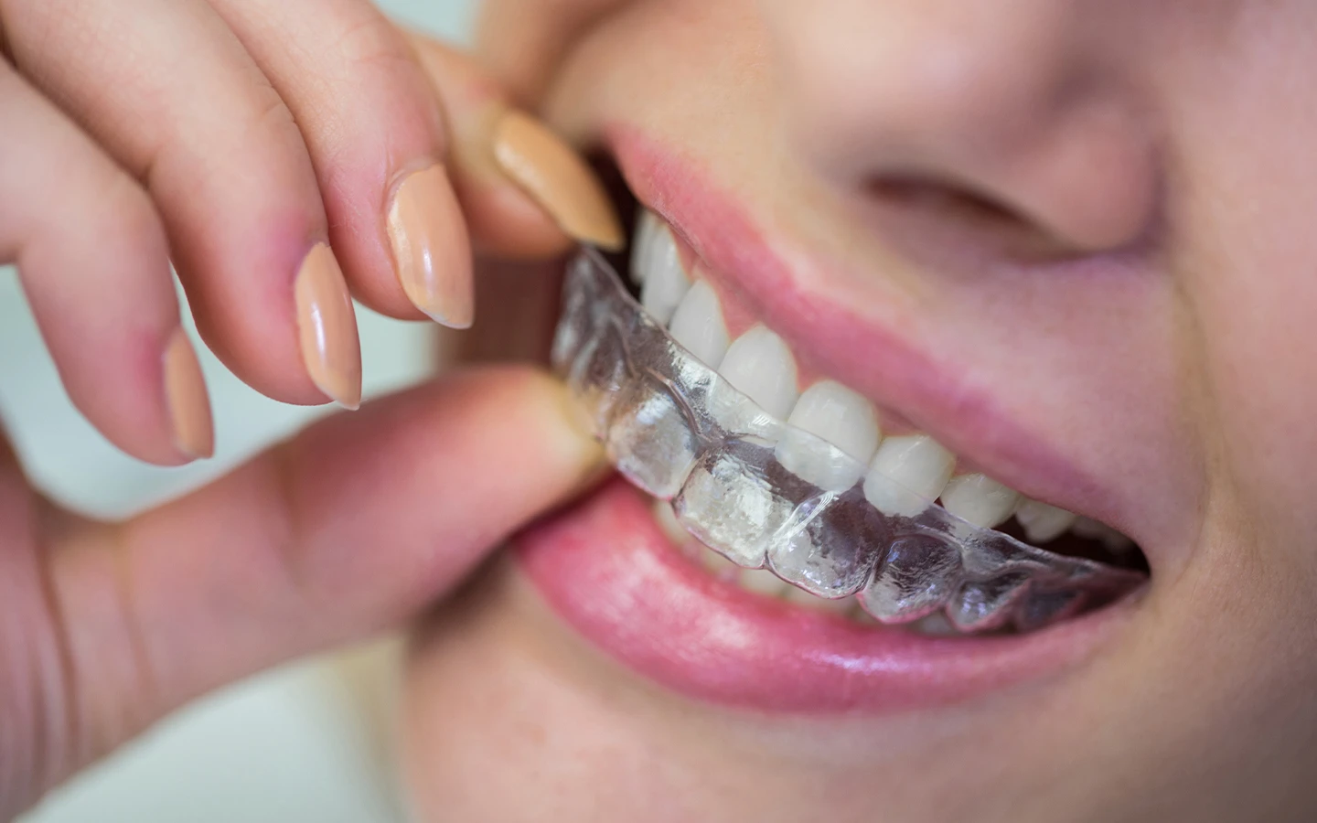 Specialized invisalign treatment in Florida